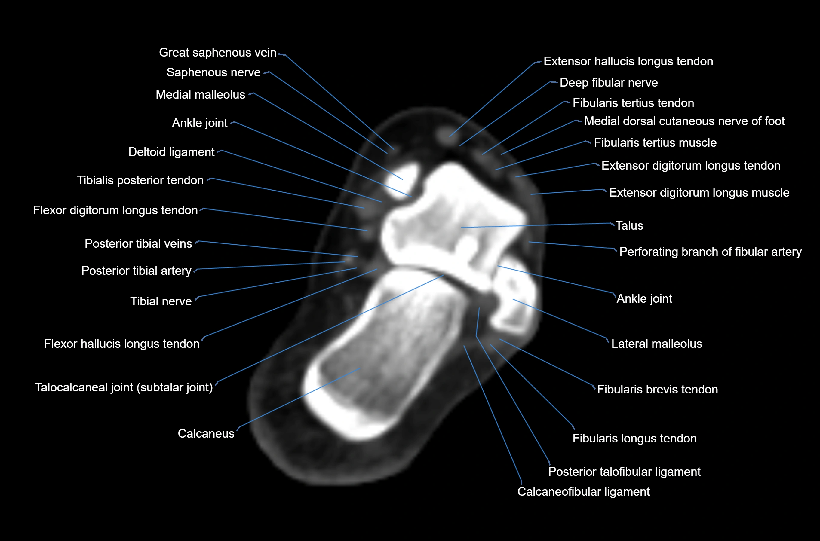 CT Ankle axial cross sectional anatomy labelled image -00033.webp